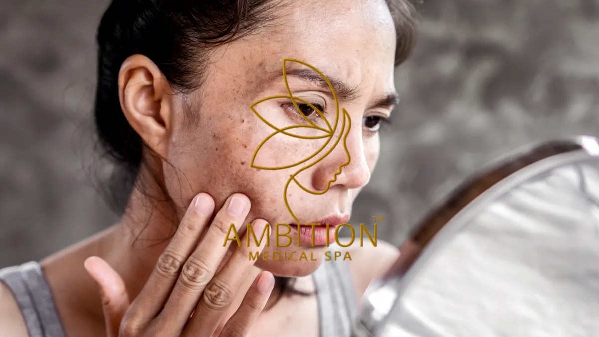 Ambition Medical Spa | What is Hyperpigmentation?