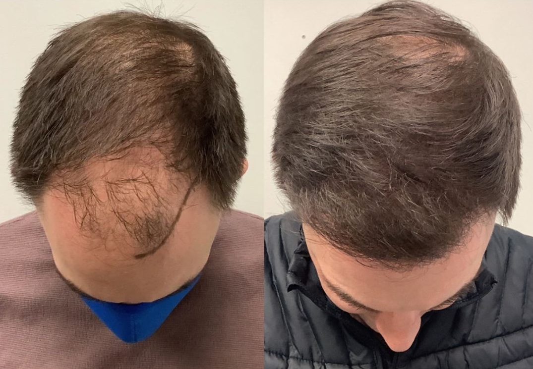 Thinking About a Hair Transplant Abroad? Read This Before You Risk Your Results