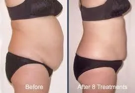 before and after torso for laser lipo