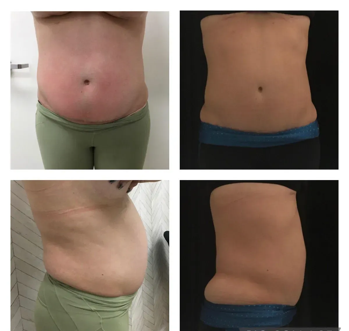 woman's midsection before and after laser lipo