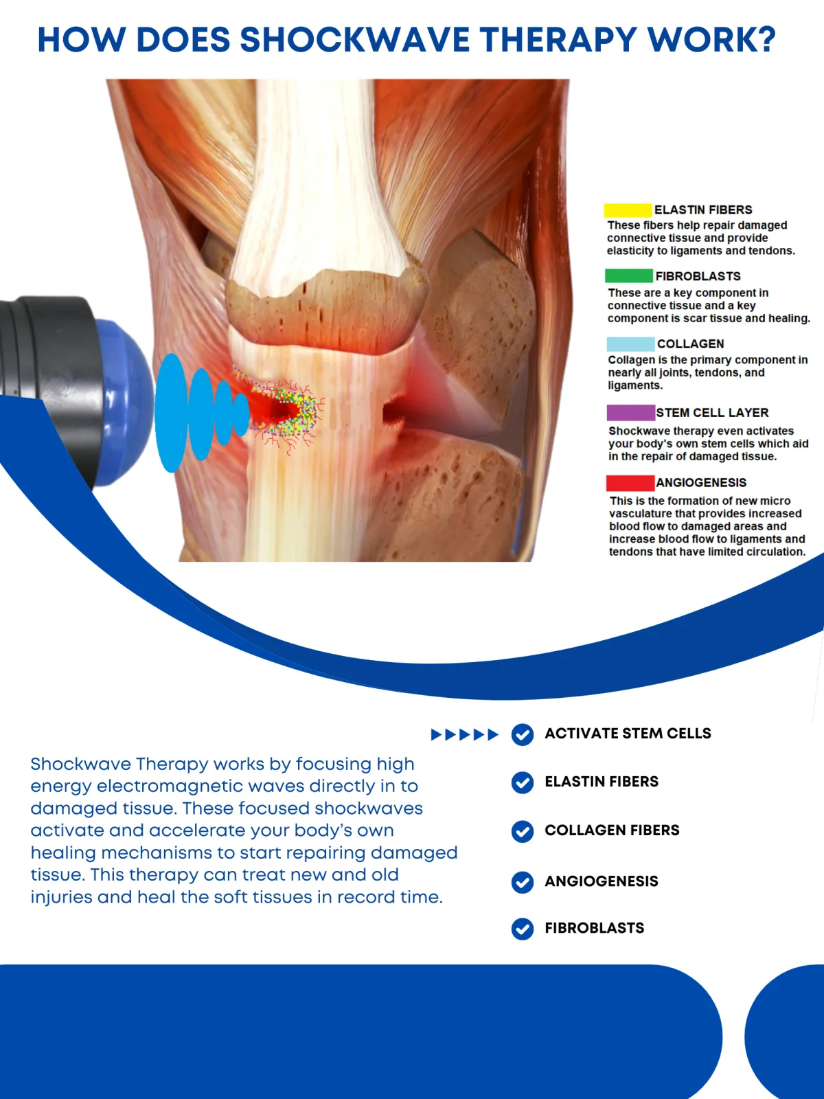 shockwave illustration shows acoustic waves penetrating from skin to tendon
