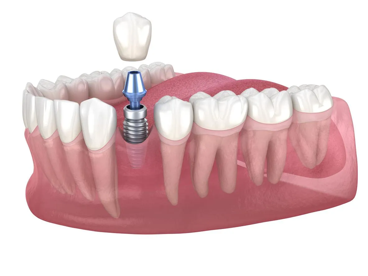 Single Implant