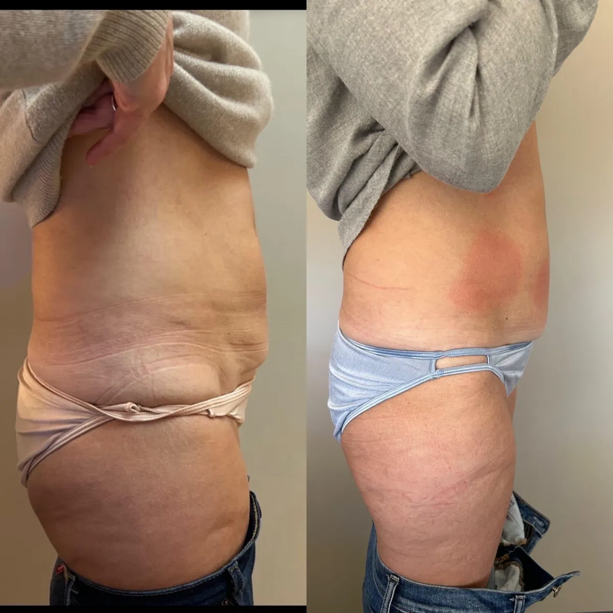 red light therapy before and after woman