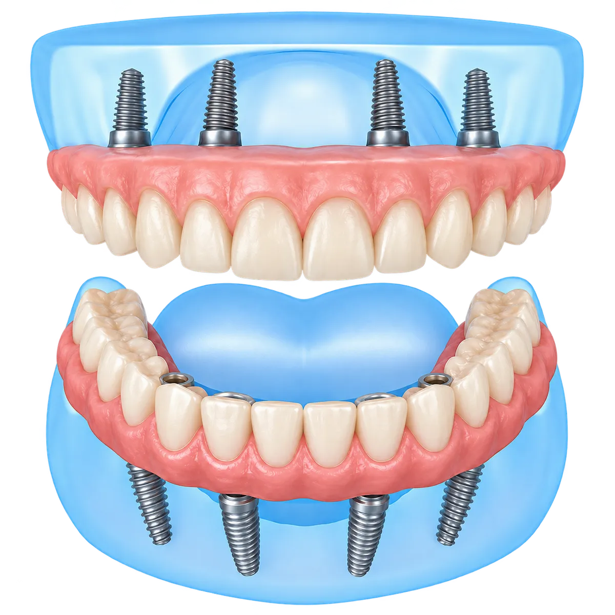 All-On-4 Implants