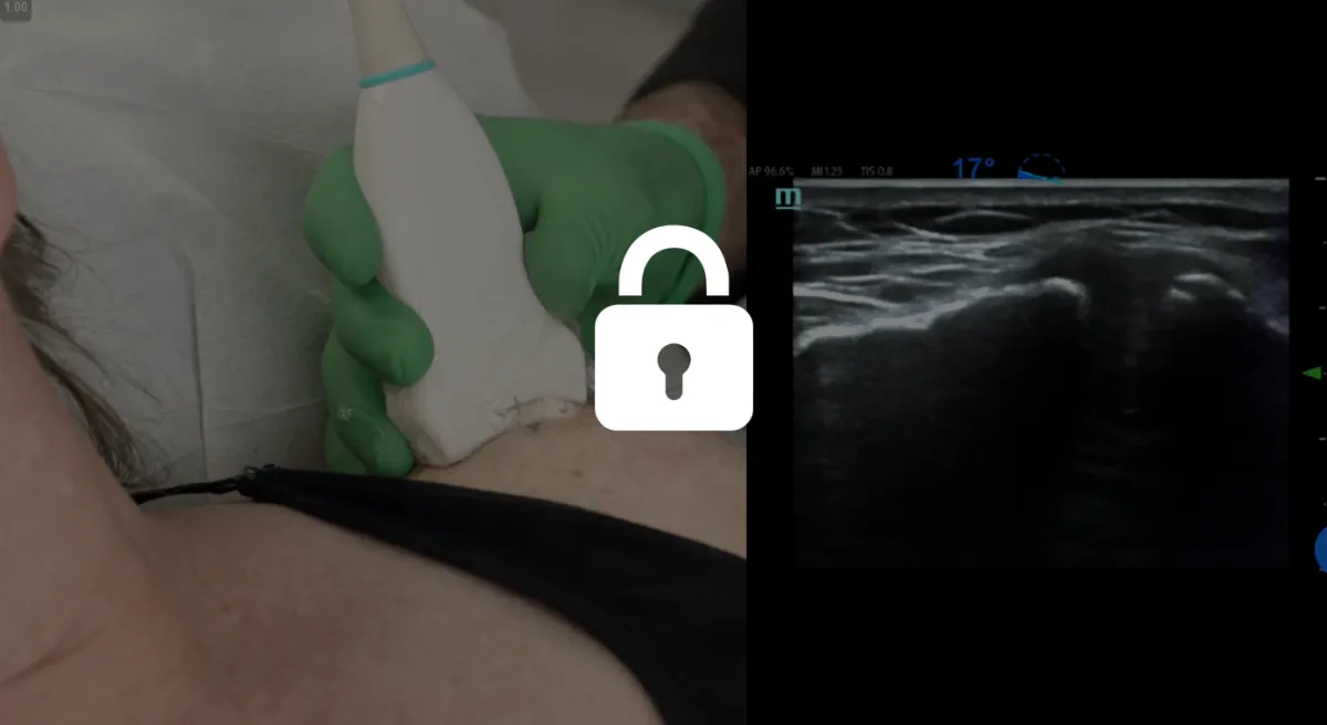 PRP Masters Shoulder 4th Injection Site