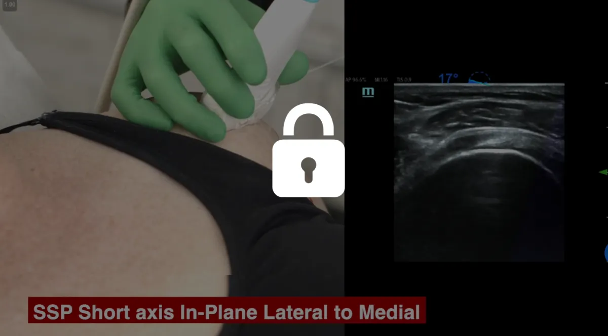 PRP Masters Shoulder 3rd Injection Site