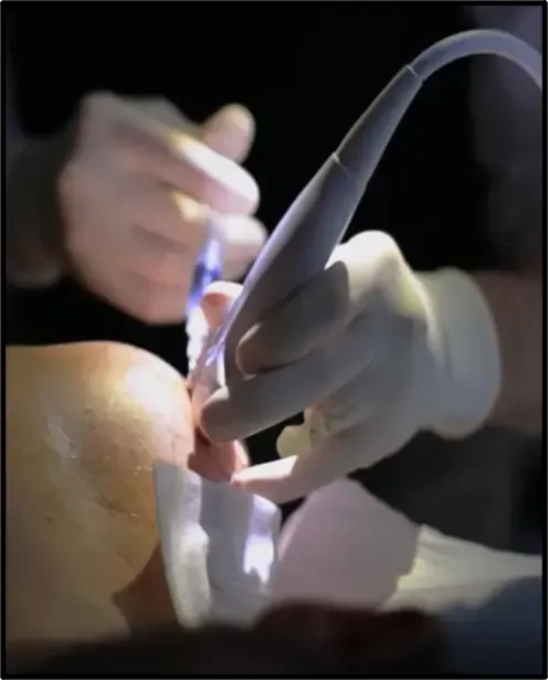 Medical professional injecting high-density Platelet Rich Plasma (PRP) into a patient's knee for regenerative treatment.