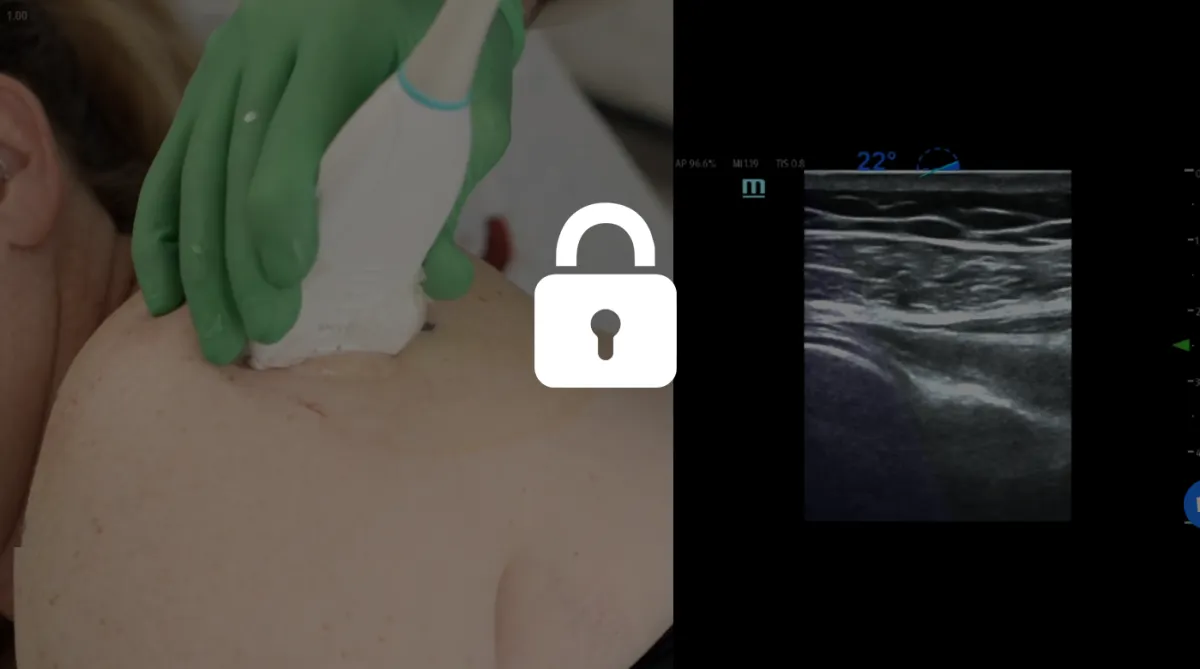 PRP Masters Shoulder 5th Injection Site