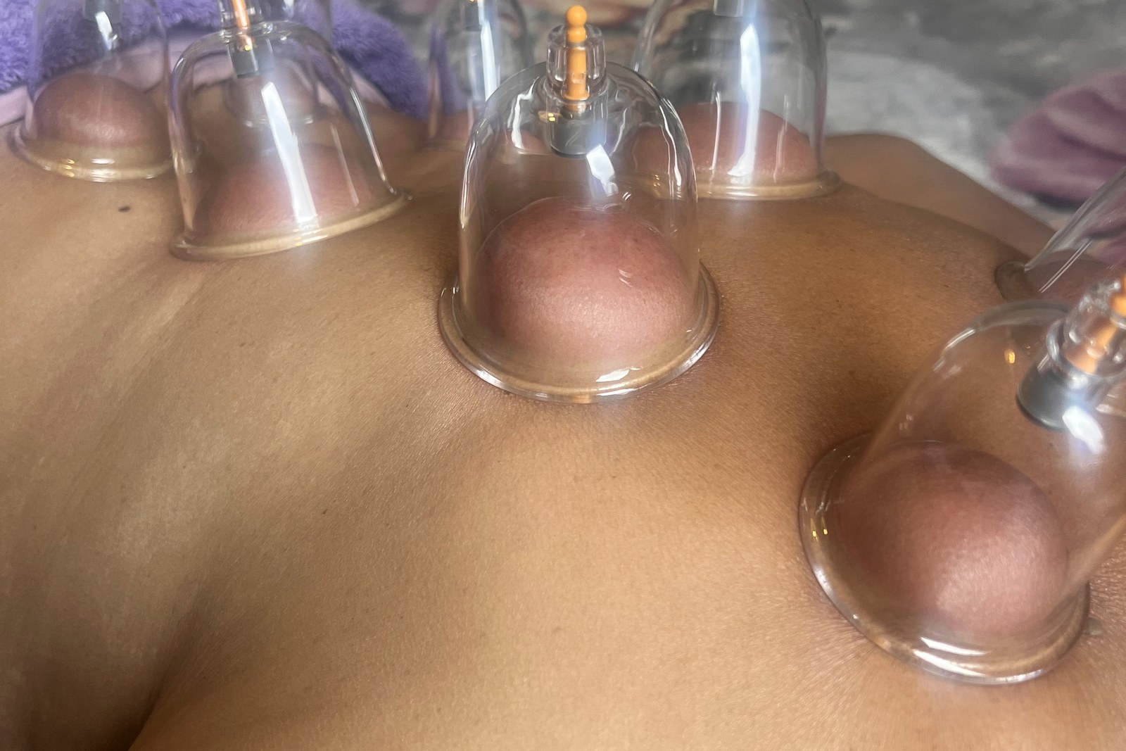 Cupping Marks: How Long They Last, and How to Plan Around Them