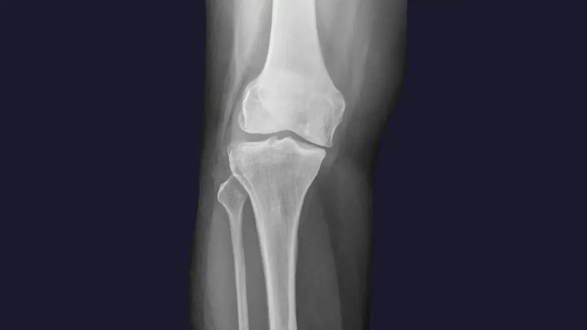 Knee and Foot Pain Relief Dayton, OH