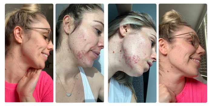 Hormonal Acne Cure