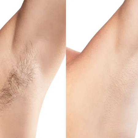 laser hair removal macomb county