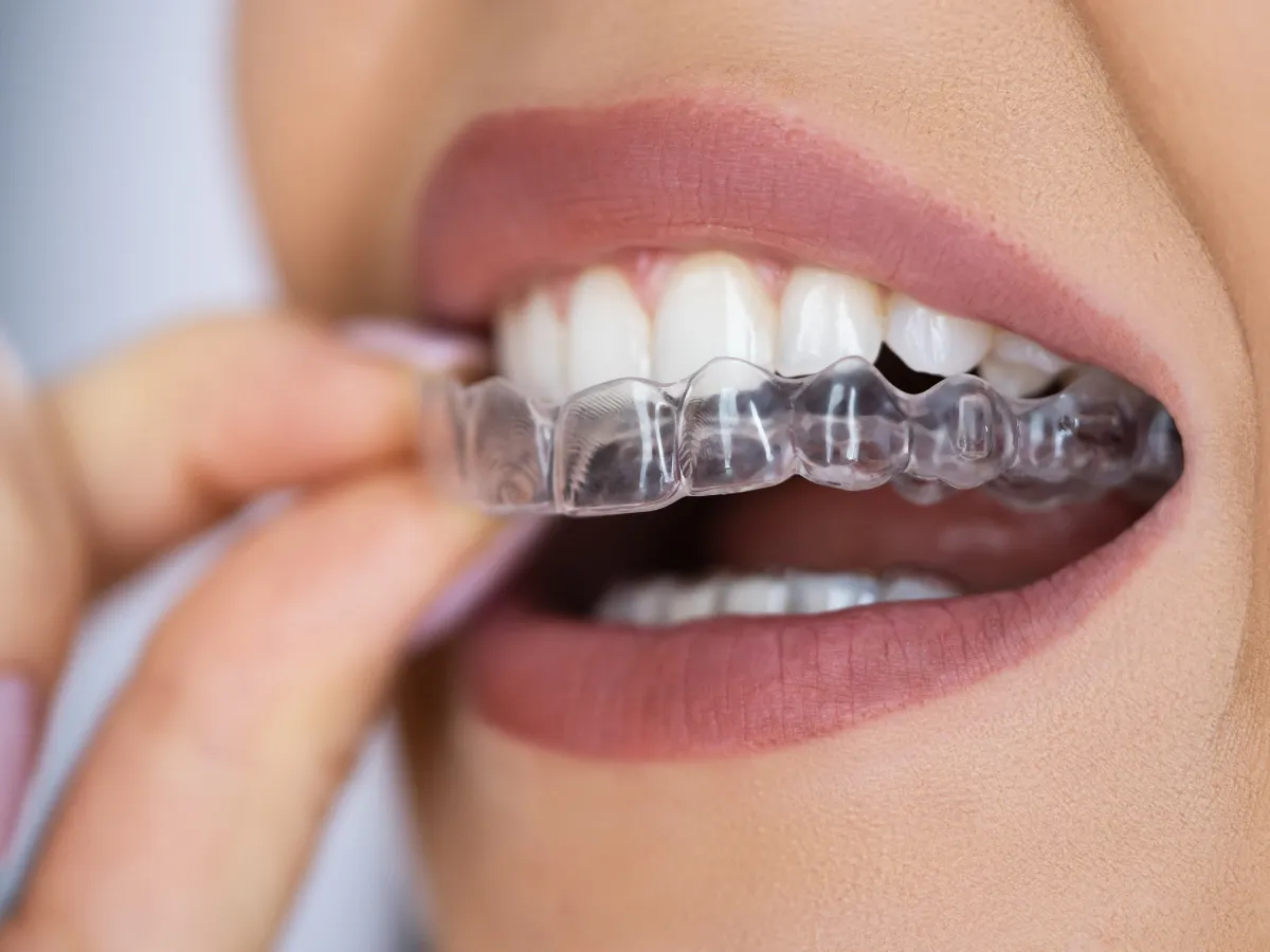 Invisalign® Clear Aligners