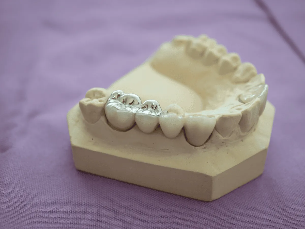 amalgam fillings