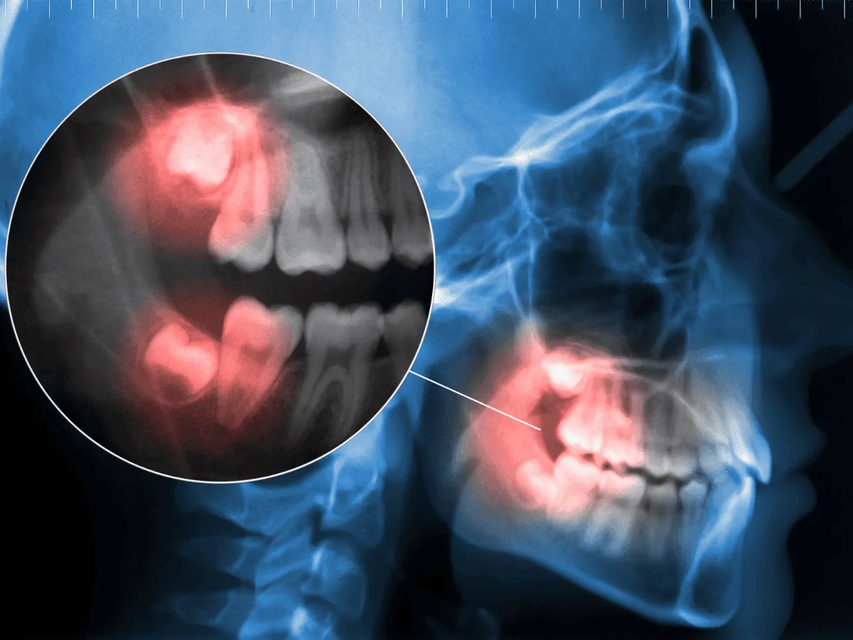 Impacted Tooth