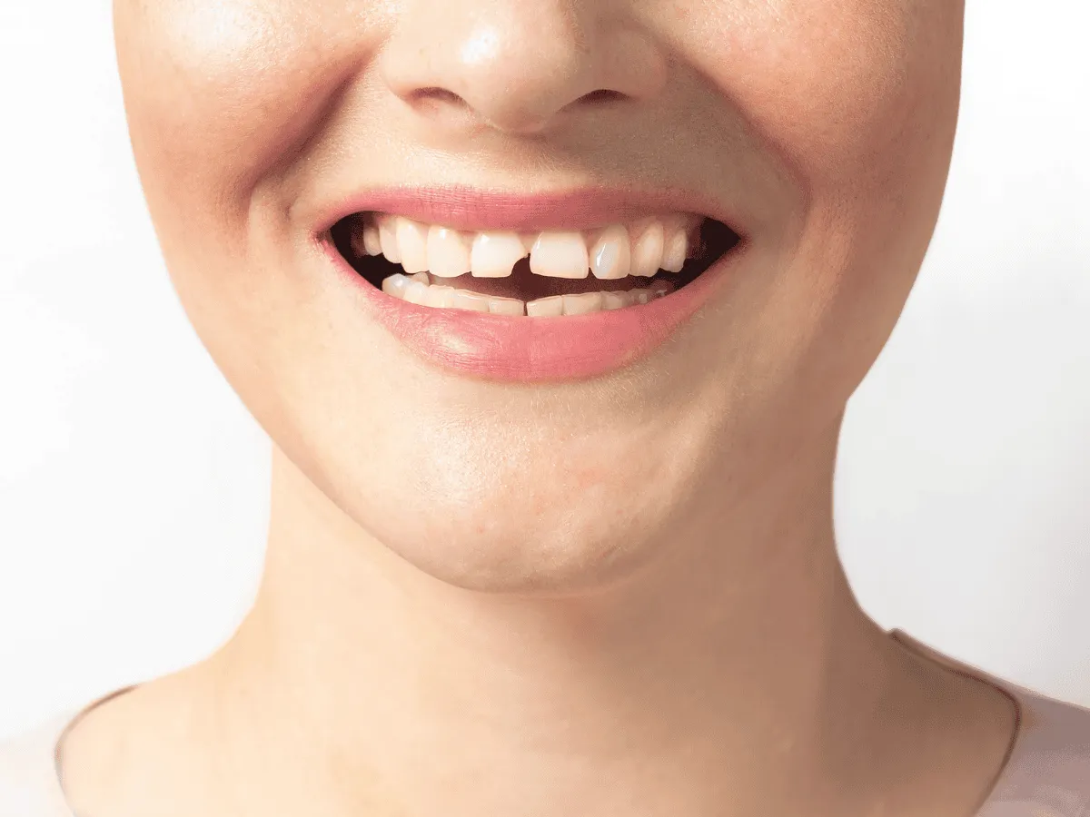 Veneers