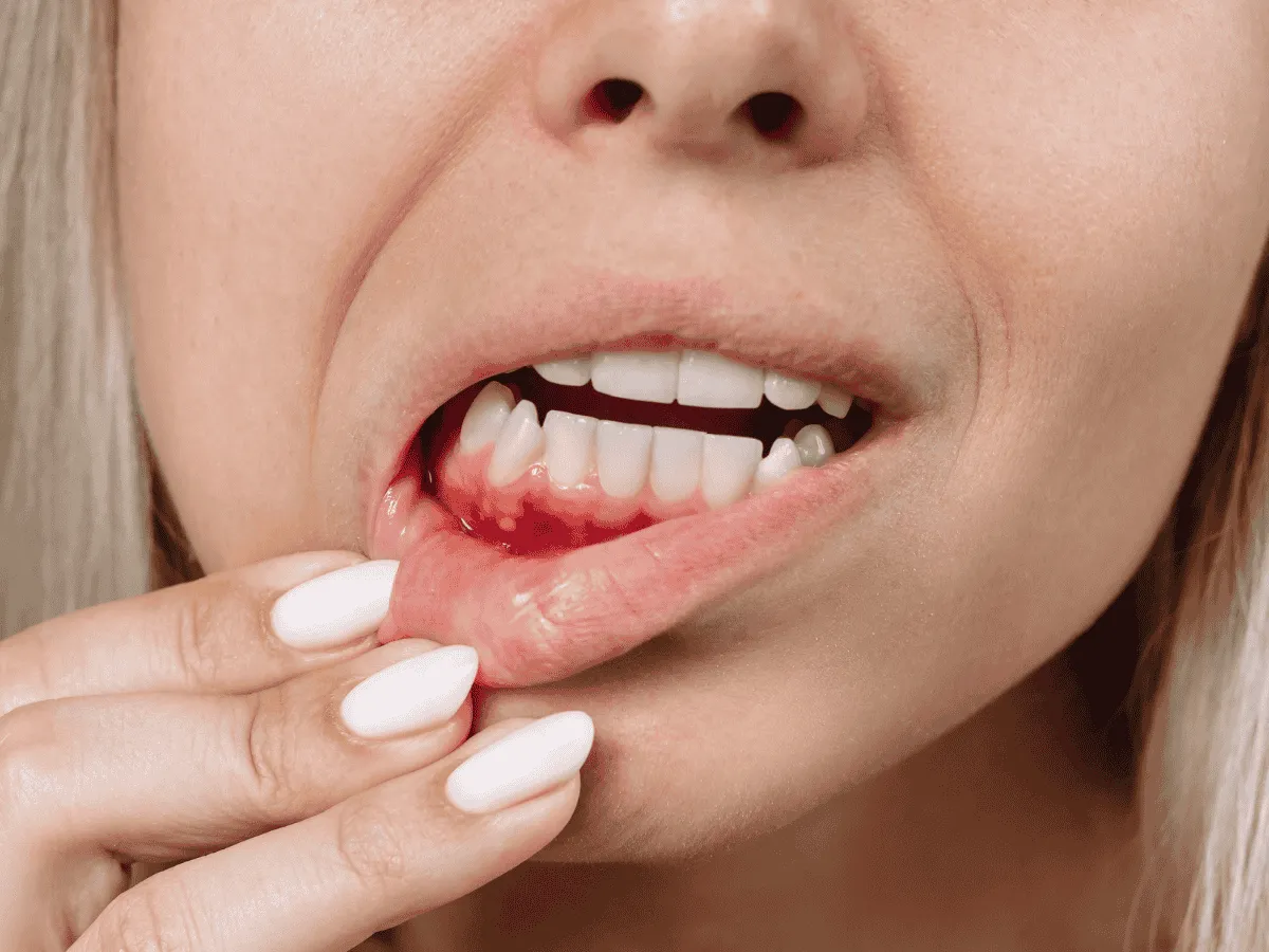 Dental Filling
