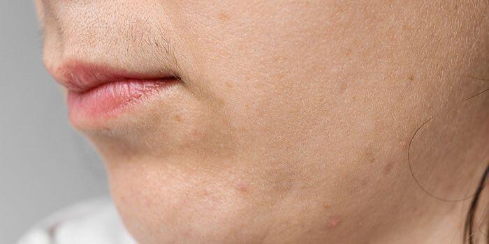 Facial Hair Removal for Women | Treuvis Med Spa