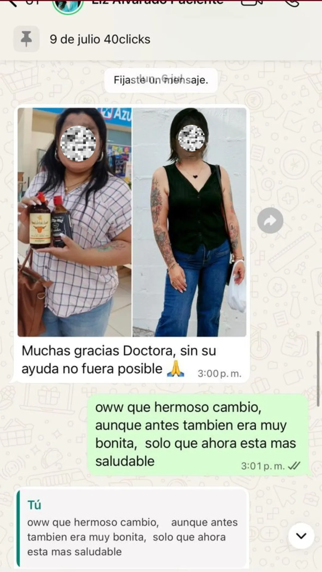Resultado de paciente - Mamoplastia