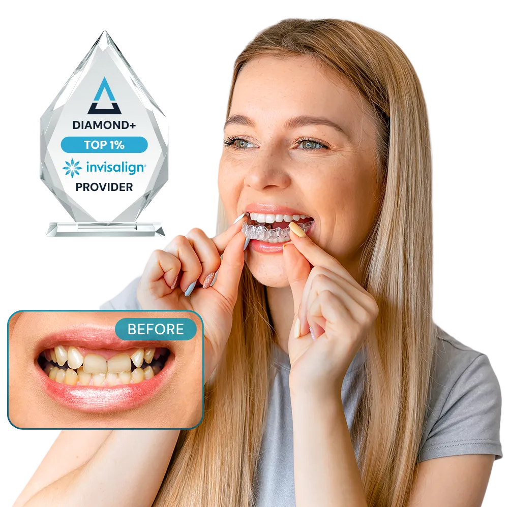 Example of before and after Invisalign and Whitening Treatment