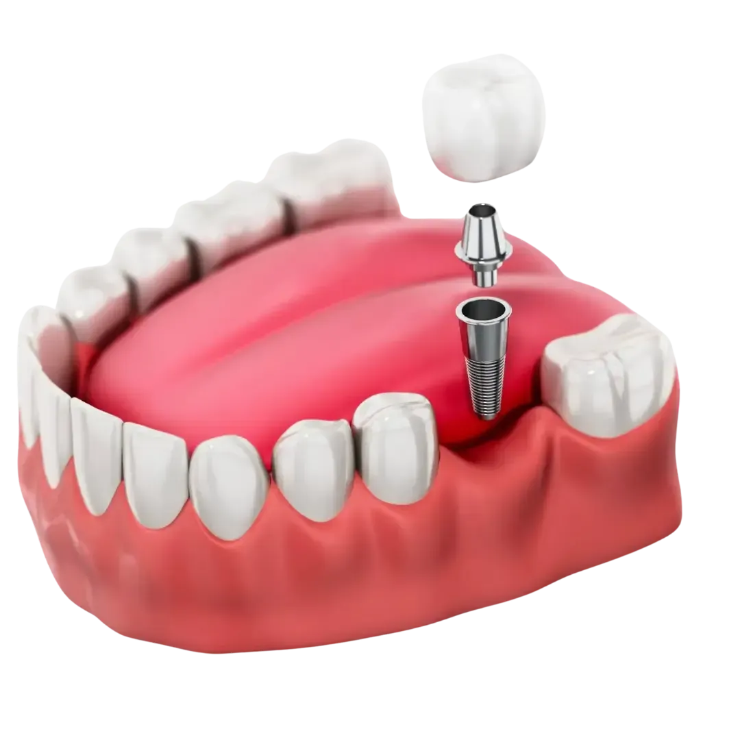 Tooth Implant