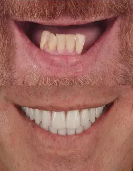 Fixed Dentures