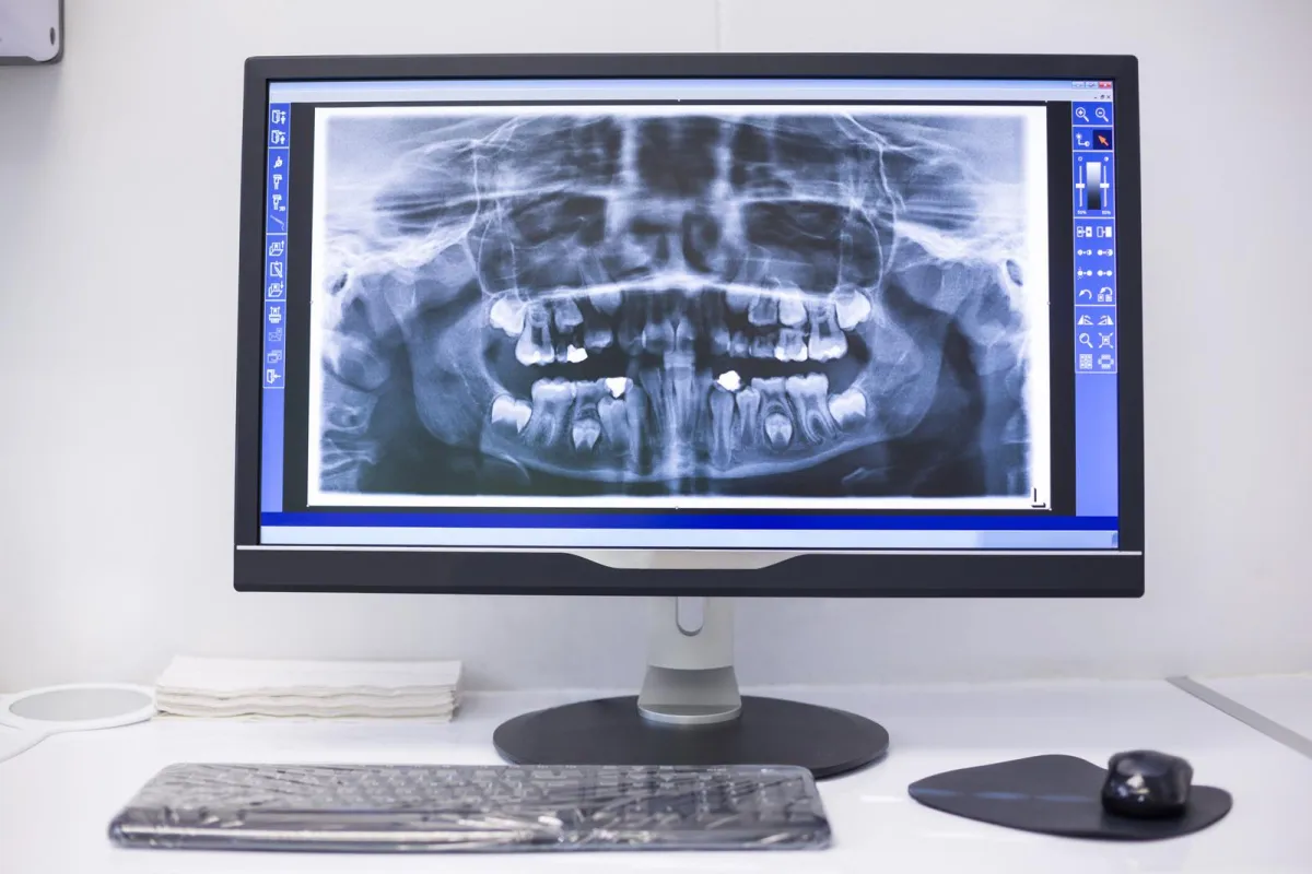 a computer screen with x-ray of teeth