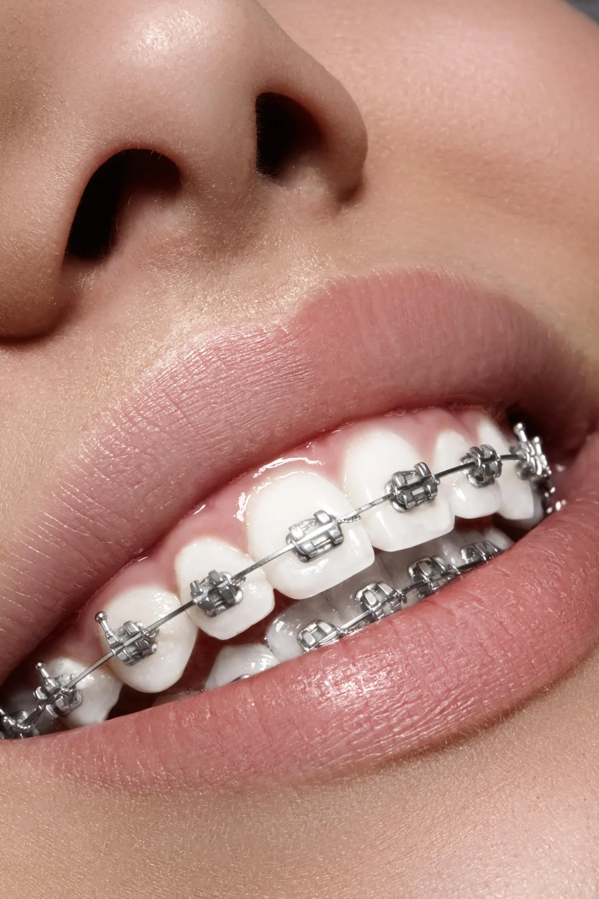 a person with braces