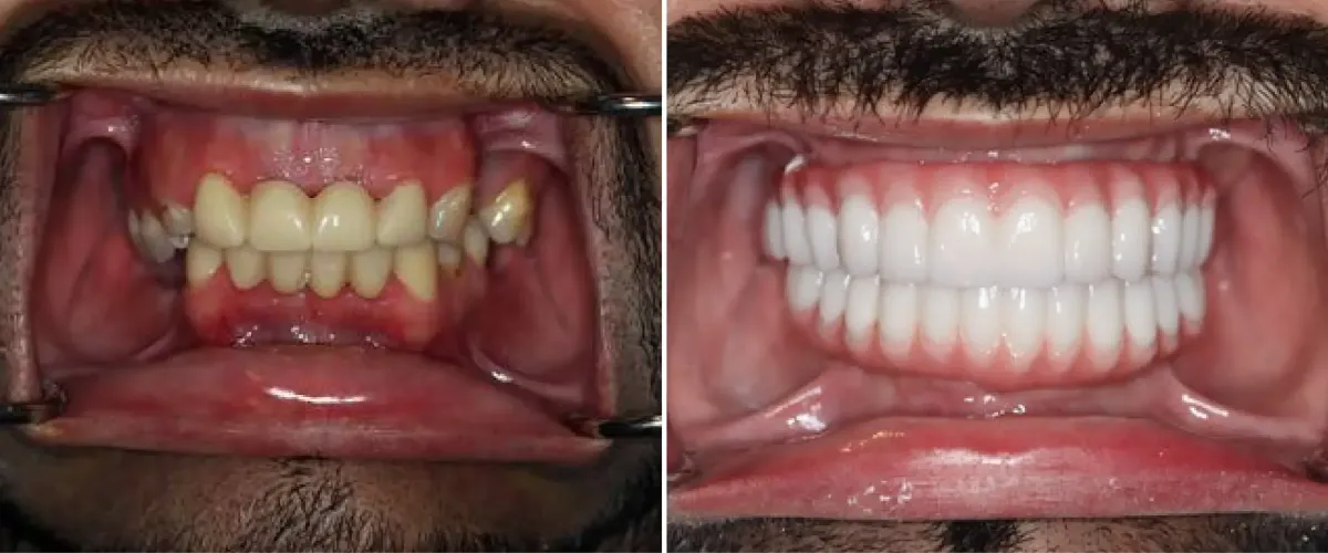 Sacramento Dental Implant Before & After