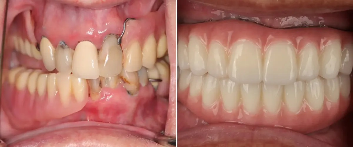 Sacramento Dental Implant Before & After