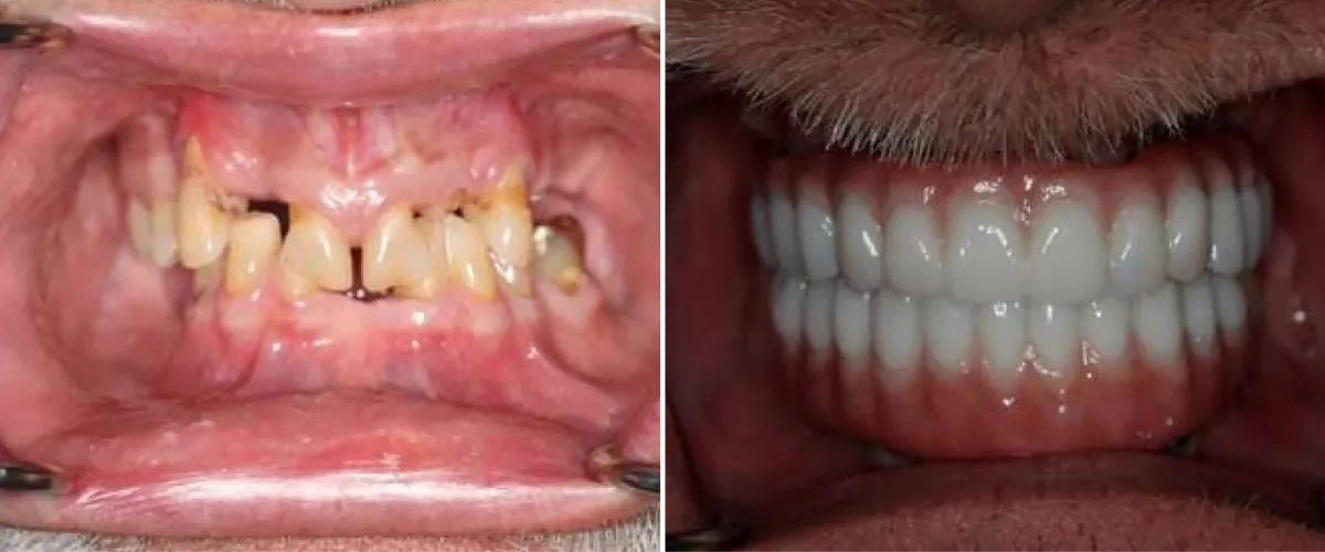 Sacramento Dental Implant Before & After