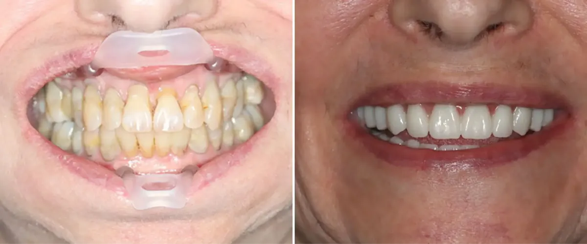 Sacramento Dental Implant Before & After