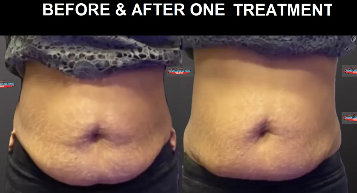 premier laser fat loss, laser fat loss, body sculpting, body contouring, denver, colorado, greenwood village, lipo laser, laser lipo