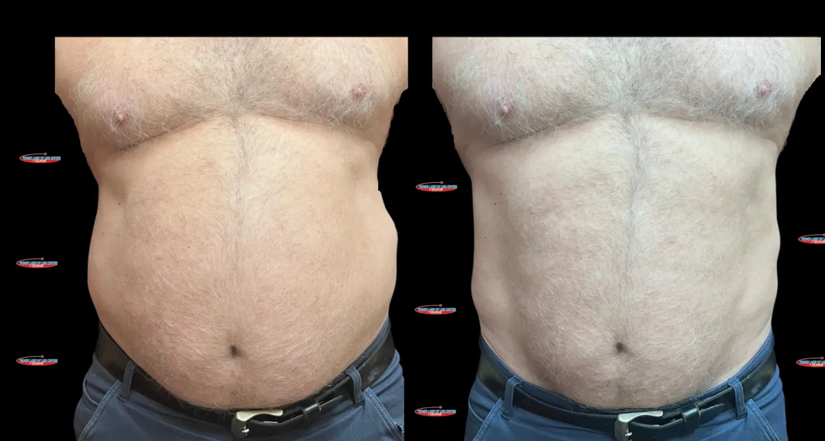 premier laser fat loss, laser fat loss, body sculpting, body contouring, denver, colorado, greenwood village, lipo laser, laser lipo