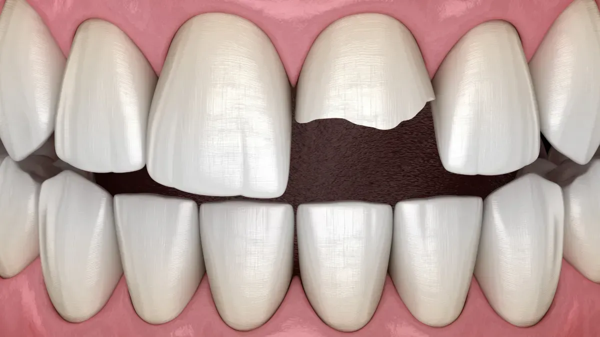 Broke Or Chipped A Tooth