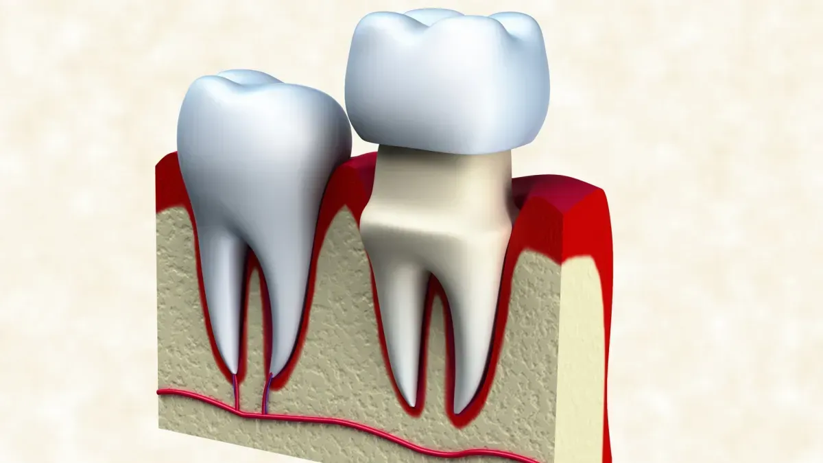 Broken or Lost Crown or Filling