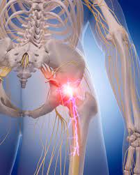 Sciatica or Other Types of Back Pain