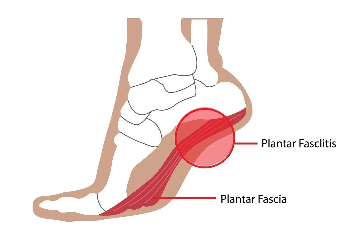 Plantar Fasciitis Pain Treatment Evansville Indiana