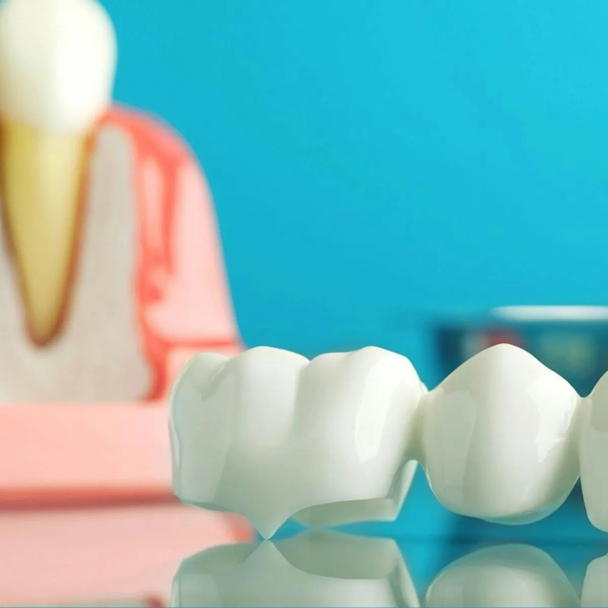 Dental implants
