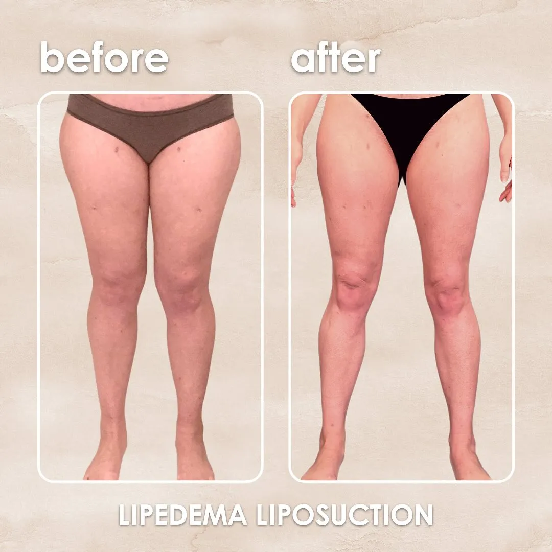 Lipedema before-and-after comparison.