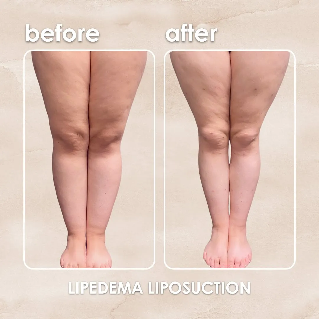 Lipedema before-and-after comparison.