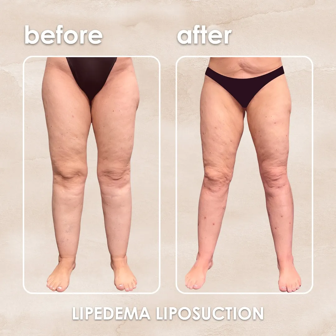 Lipedema before-and-after comparison.