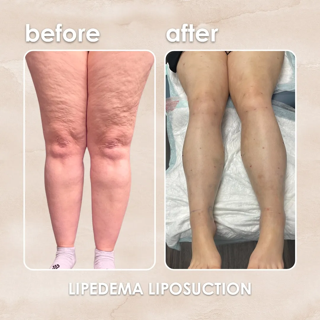 Lipedema before-and-after comparison.