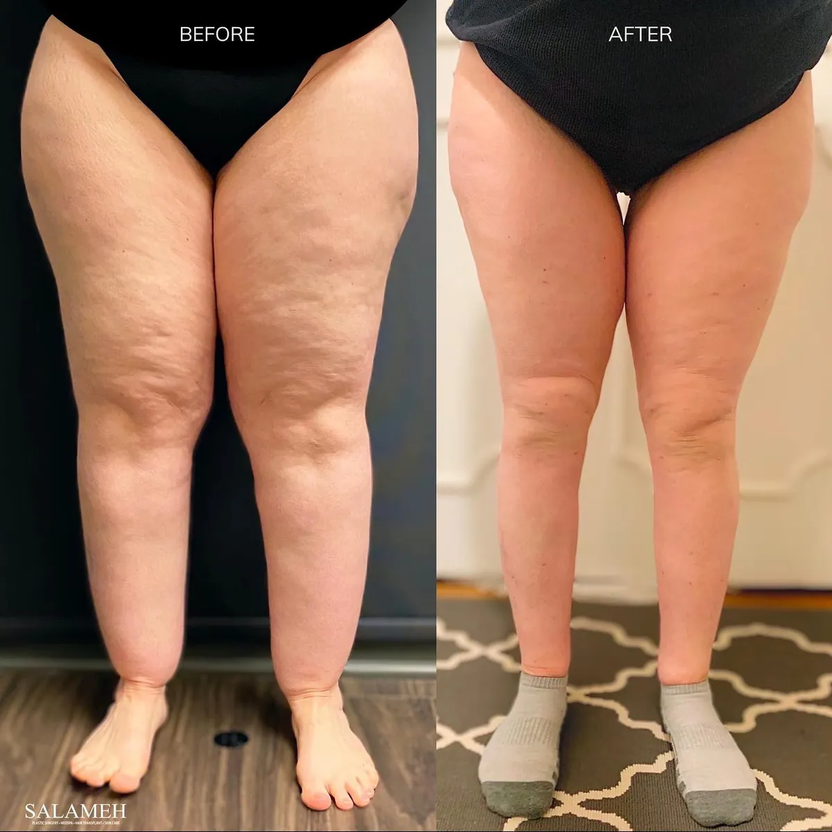 Lipedema before-and-after comparison.