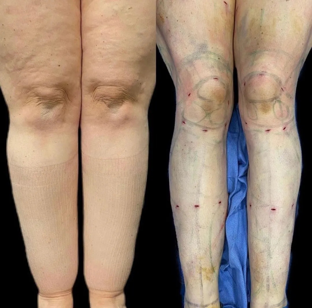 Lipedema before-and-after comparison.