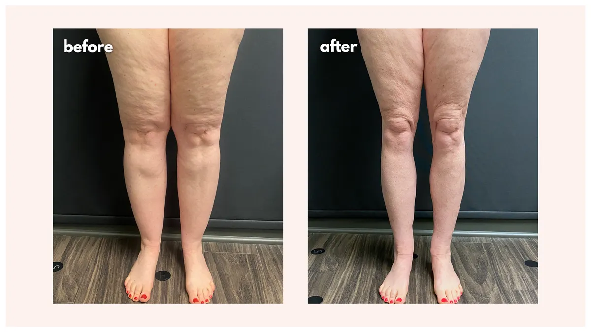 Lipedema before-and-after comparison.