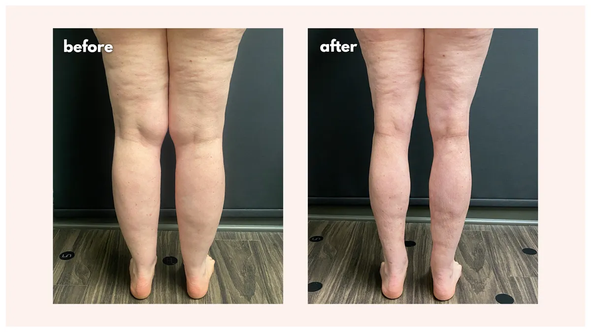 Lipedema before-and-after comparison.