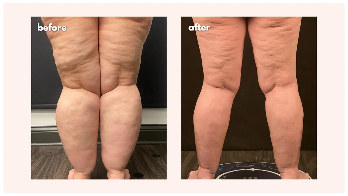 Lipedema before-and-after comparison.