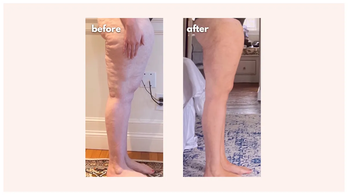 Lipedema before-and-after comparison.
