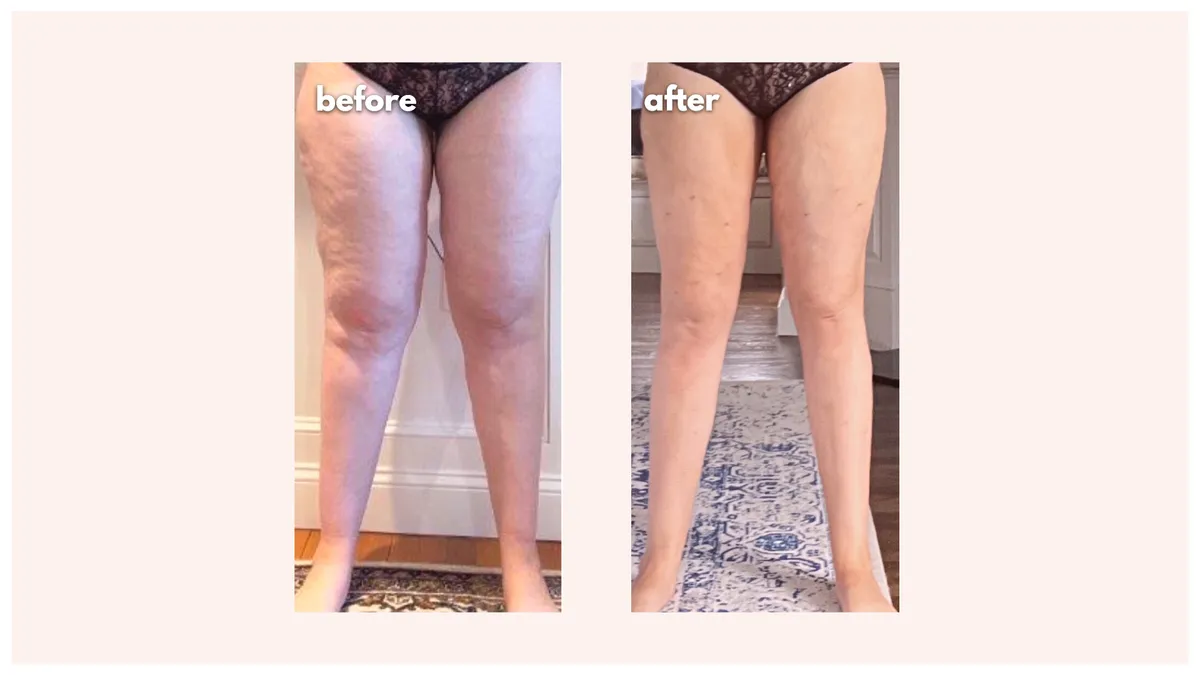 Lipedema before-and-after comparison.